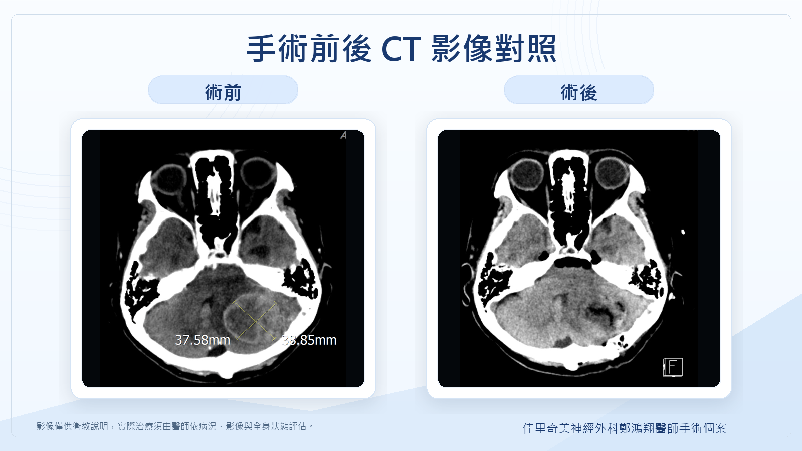 肺癌轉移性腦腫瘤術前術後影像對照